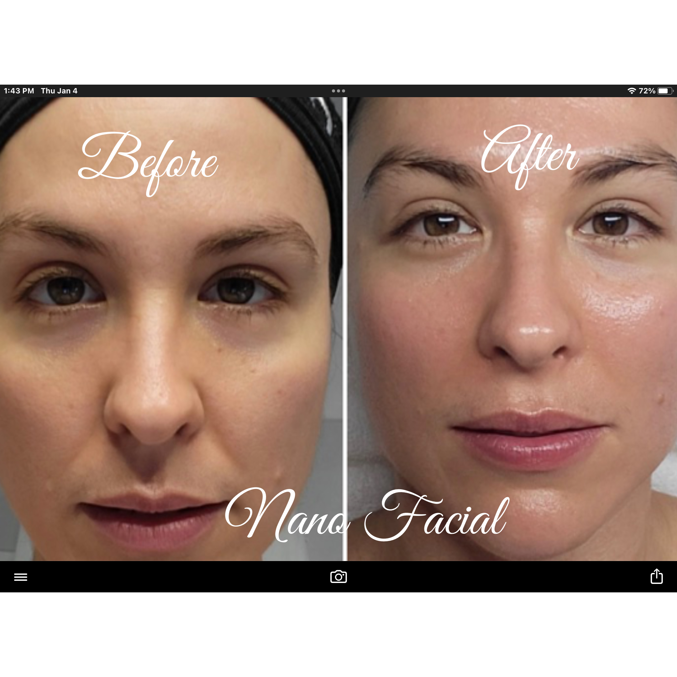Nano Facial